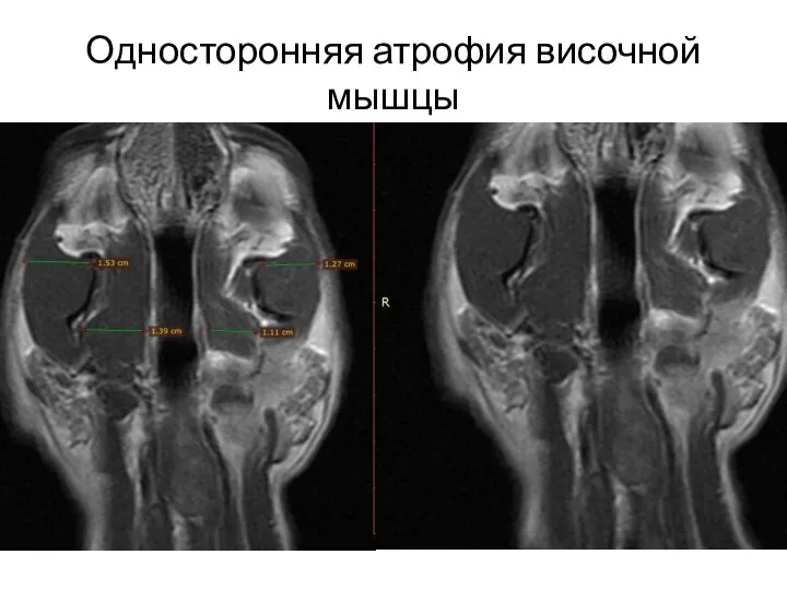 Односторонняя атрофия височной мышцы