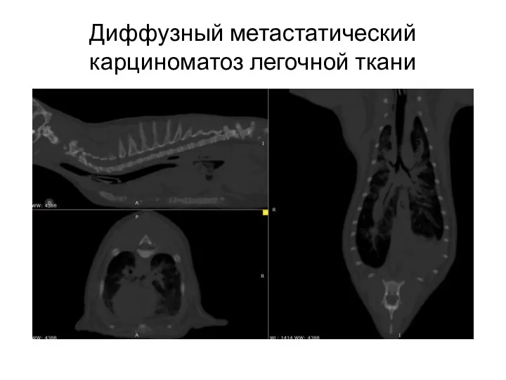 Диффузный метастатический карциноматоз легочной ткани