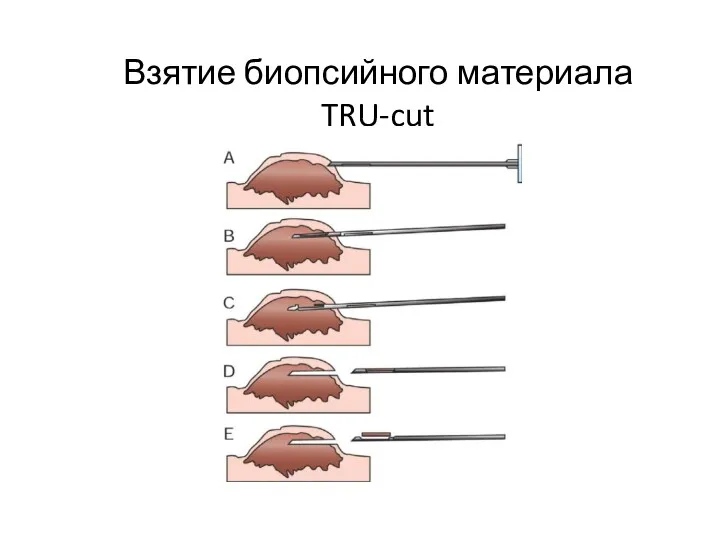 Взятие биопсийного материала TRU-cut
