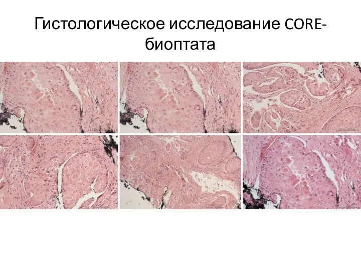 Гистологическое исследование CORE-биоптата CORE-биопсия