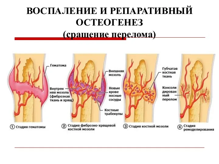 ВОСПАЛЕНИЕ И РЕПАРАТИВНЫЙ ОСТЕОГЕНЕЗ (сращение перелома)