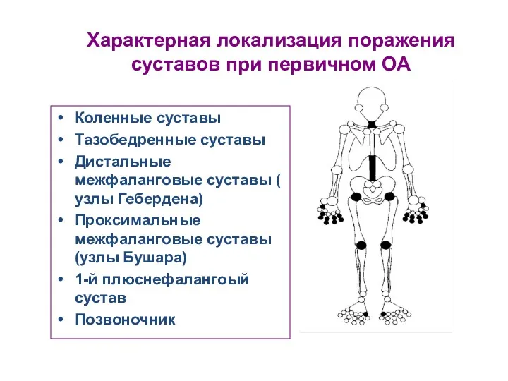Характерная локализация поражения суставов при первичном ОА Коленные суставы Тазобедренные суставы Дистальные межфаланговые