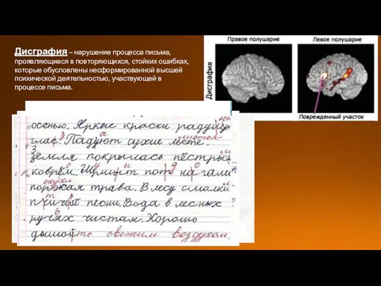 Дисграфия – нарушение процесса письма, проявляющиеся в повторяющихся, стойких ошибках,