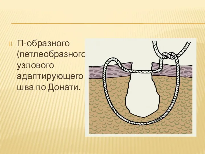 П-образного (петлеобразного) узлового адаптирующего шва по Донати.