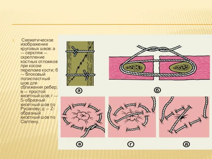 Схематическое изображение круговых швов: а — серкляж — скрепление костных