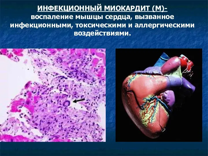 ИНФЕКЦИОННЫЙ МИОКАРДИТ (М)- воспаление мышцы сердца, вызванное инфекционными, токсическими и аллергическими воздействиями.
