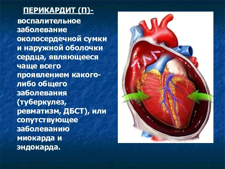 ПЕРИКАРДИТ (П)- воспалительное заболевание околосердечной сумки и наружной оболочки сердца, являющееся чаще всего