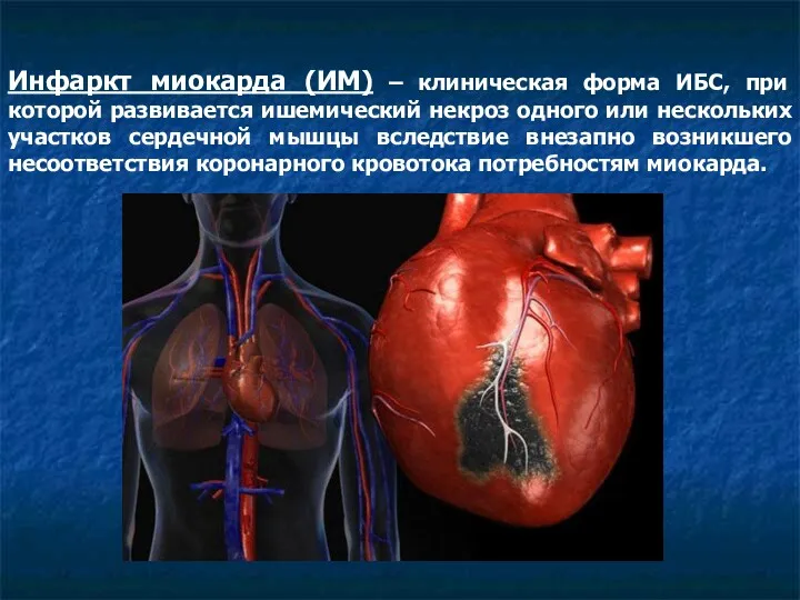 Инфаркт миокарда (ИМ) – клиническая форма ИБС, при которой развивается ишемический некроз одного