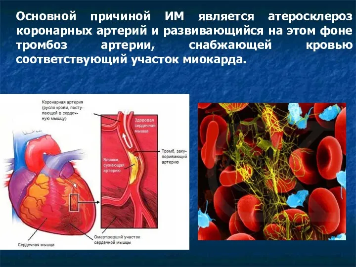 Основной причиной ИМ является атеросклероз коронарных артерий и развивающийся на этом фоне тромбоз
