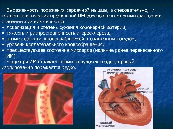 Выраженность поражения сердечной мышцы, а следовательно, и тяжесть клинических проявлений ИМ обусловлены многими