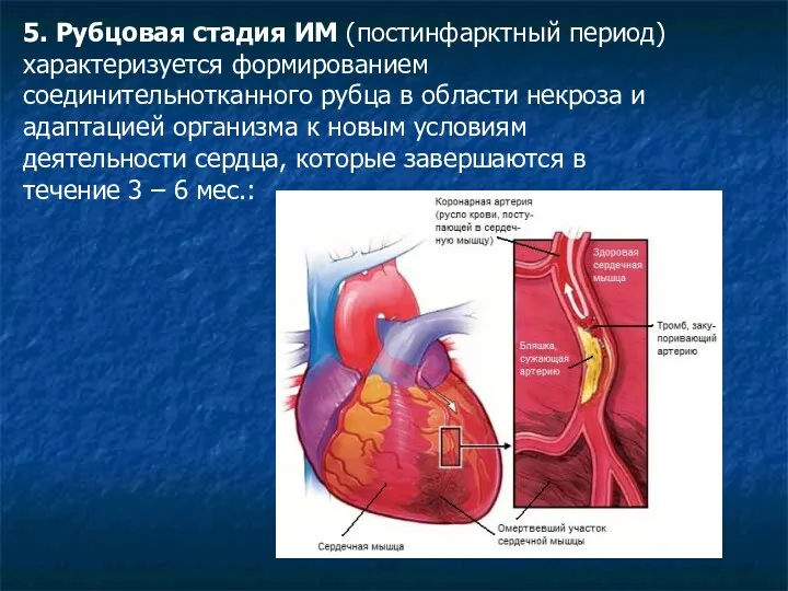 5. Рубцовая стадия ИМ (постинфарктный период) характеризуется формированием соединительнотканного рубца в области некроза