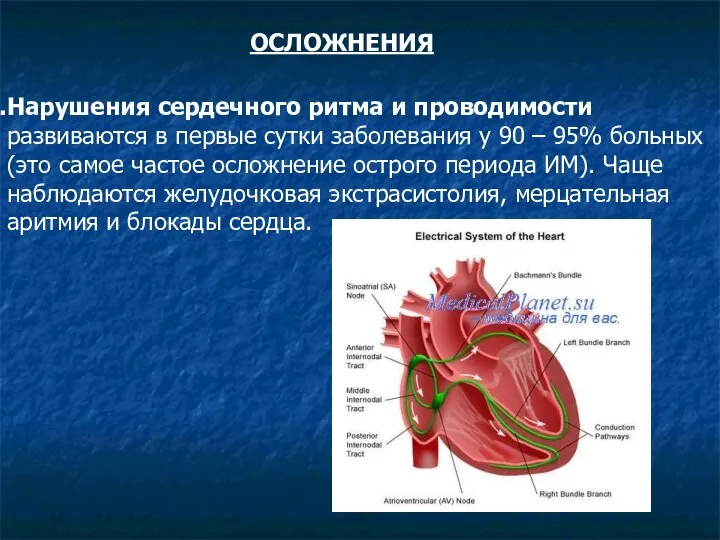 ОСЛОЖНЕНИЯ Нарушения сердечного ритма и проводимости развиваются в первые сутки заболевания у 90