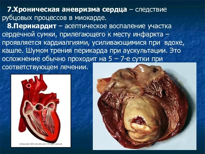 7.Хроническая аневризма сердца – следствие рубцовых процессов в миокарде. 8.Перикардит – асептическое воспаление