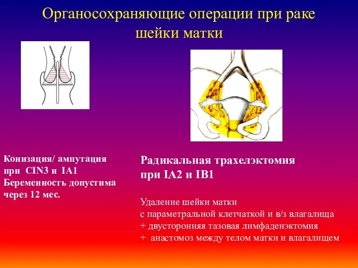 Органосохраняющие операции при раке шейки матки Конизация/ ампутация при CIN3