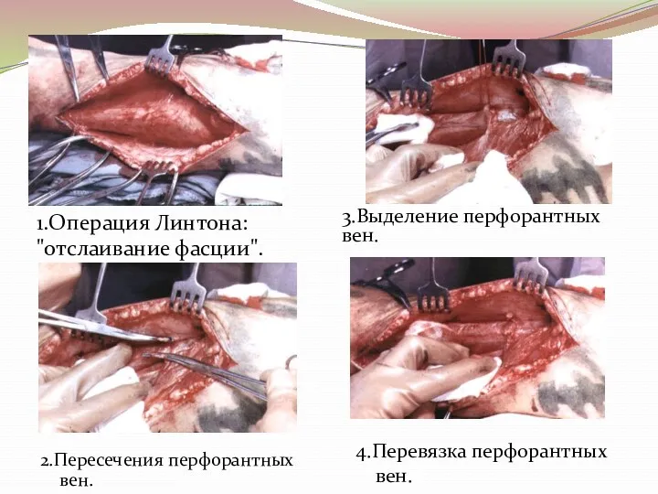 1.Операция Линтона: "отслаивание фасции". 3.Выделение перфорантных вен. 2.Пересечения перфорантных вен. 4.Перевязка перфорантных вен.