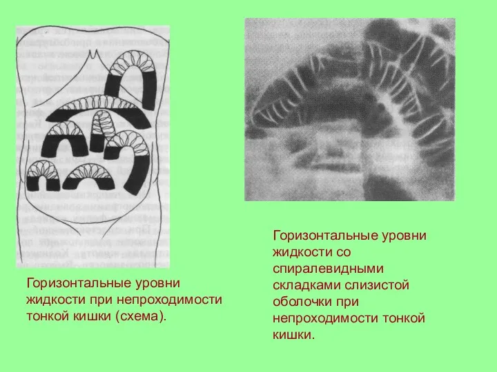 Горизонтальные уровни жидкости при непроходимости тонкой кишки (схема). Горизонтальные уровни жидкости со спиралевидными