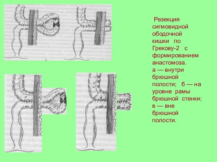 Резекция сигмовидной ободочной кишки по Грекову-2 с формированием анастомоза. а — внутри брюшной