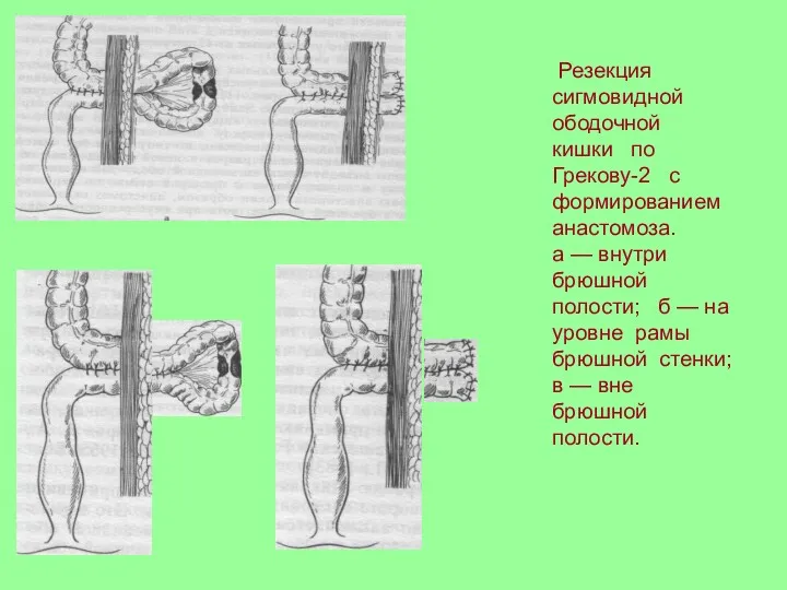 Резекция сигмовидной ободочной кишки по Грекову-2 с формированием анастомоза. а