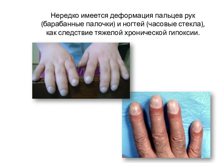 Нередко имеется деформация пальцев рук (барабанные палочки) и ногтей (часовые стекла), как следствие тяжелой хронической гипоксии.