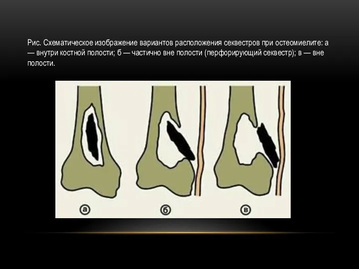 Рис. Схематическое изображение вариантов расположения секвестров при остеомиелите: а — внутри костной полости;