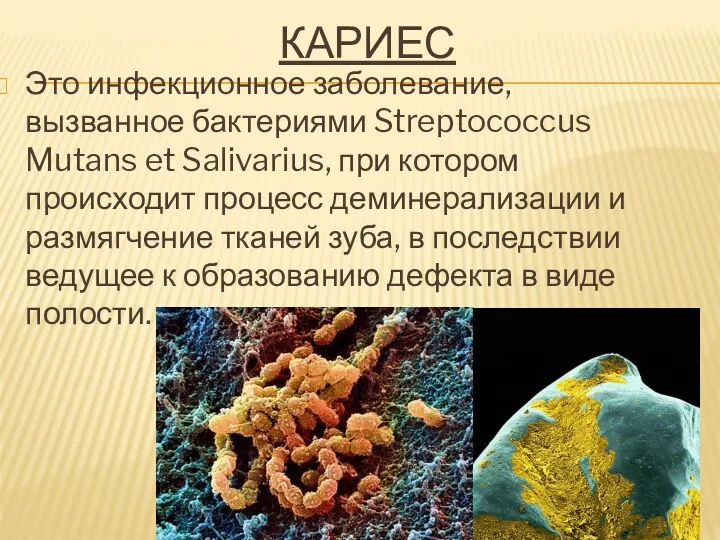 КАРИЕС Это инфекционное заболевание, вызванное бактериями Streptococcus Mutans et Salivarius,