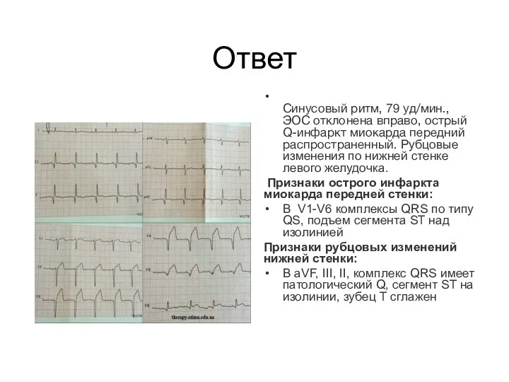 Ответ Синусовый ритм, 79 уд/мин., ЭОС отклонена вправо, острый Q-инфаркт