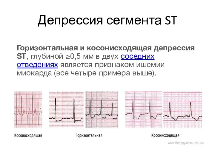 Депрессия сегмента ST Горизонтальная и косонисходящая депрессия ST, глубиной ≥0,5