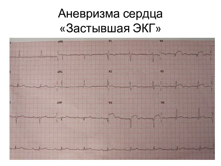Аневризма сердца «Застывшая ЭКГ»