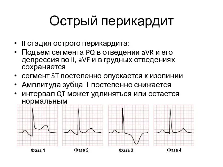 Острый перикардит II стадия острого перикардита: Подъем сегмента PQ в