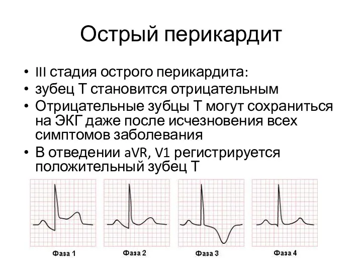 Острый перикардит III стадия острого перикардита: зубец Т становится отрицательным