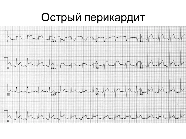 Острый перикардит