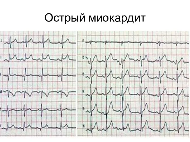 Острый миокардит