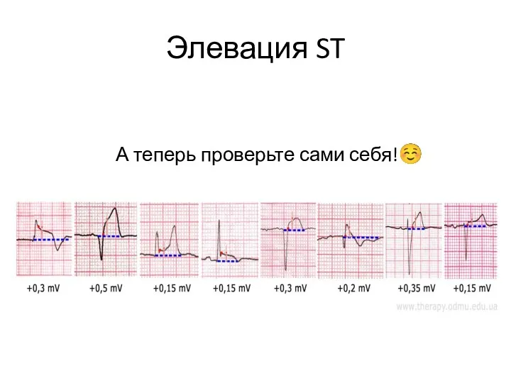 Элевация ST А теперь проверьте сами себя!☺