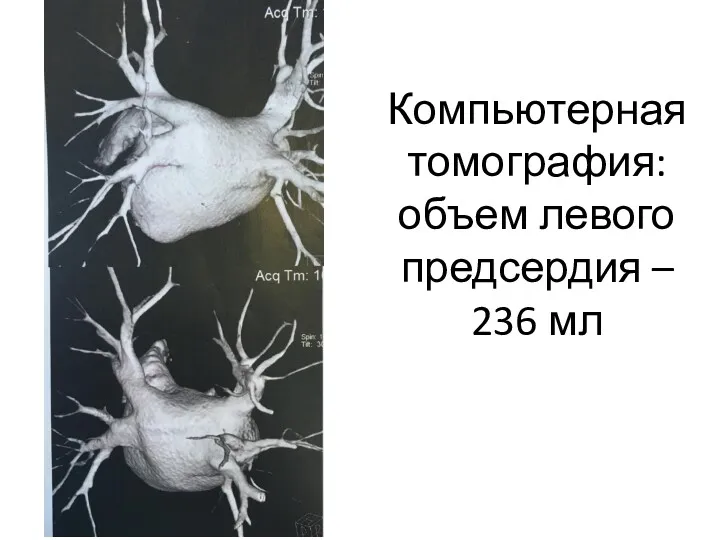 Компьютерная томография: объем левого предсердия – 236 мл