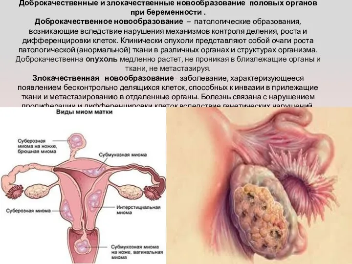 Доброкачественные и злокачественные новообразование половых органов при беременности . Доброкачественное