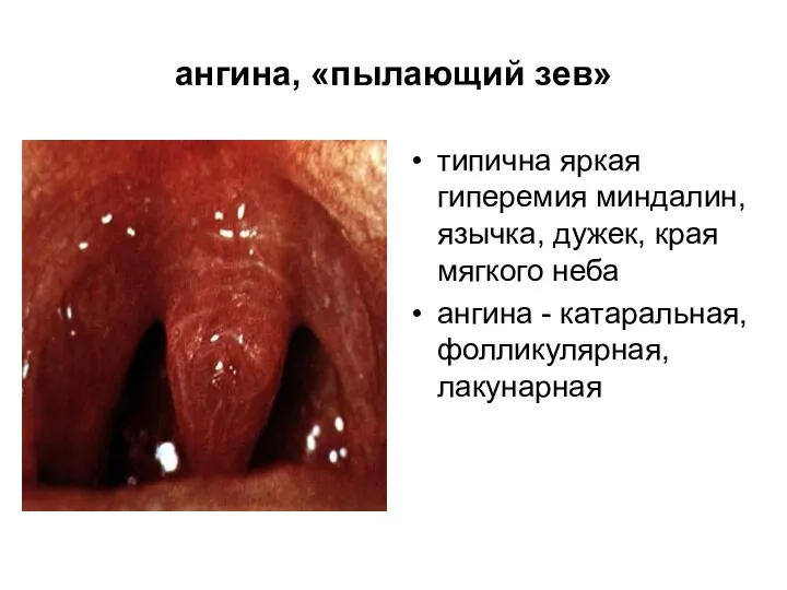 ангина, «пылающий зев» типична яркая гиперемия миндалин, язычка, дужек, края