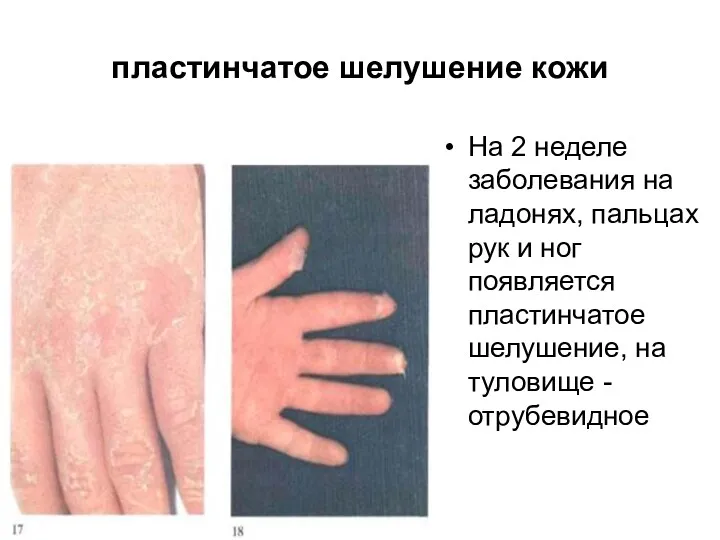 пластинчатое шелушение кожи На 2 неделе заболевания на ладонях, пальцах