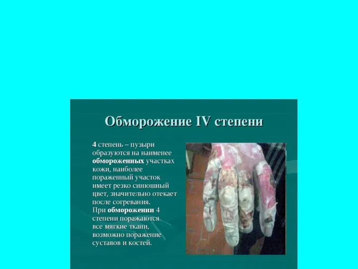 Обморожение 4 степени. Характеризуется сильными болями обмороженных участков, полным их