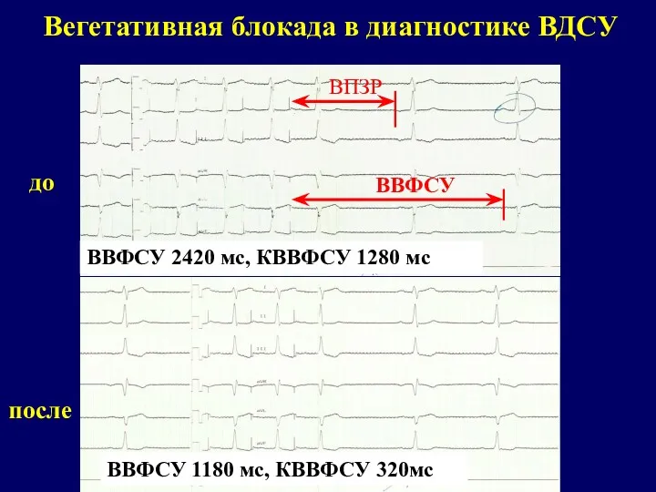 Вегетативная блокада в диагностике ВДСУ до после ВПЗР ВВФСУ ВВФСУ