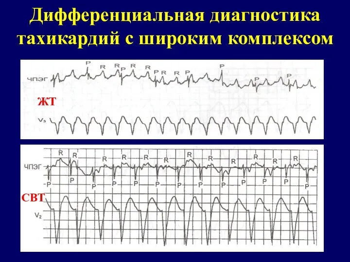 Дифференциальная диагностика тахикардий с широким комплексом ЖТ СВТ