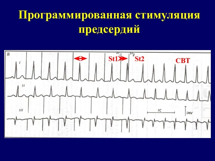 Программированная стимуляция предсердий St1 St2 СВТ