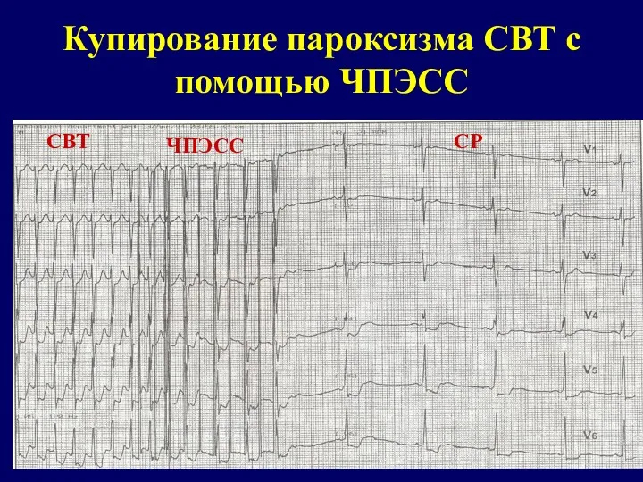 Купирование пароксизма СВТ с помощью ЧПЭСС СВТ ЧПЭСС СР