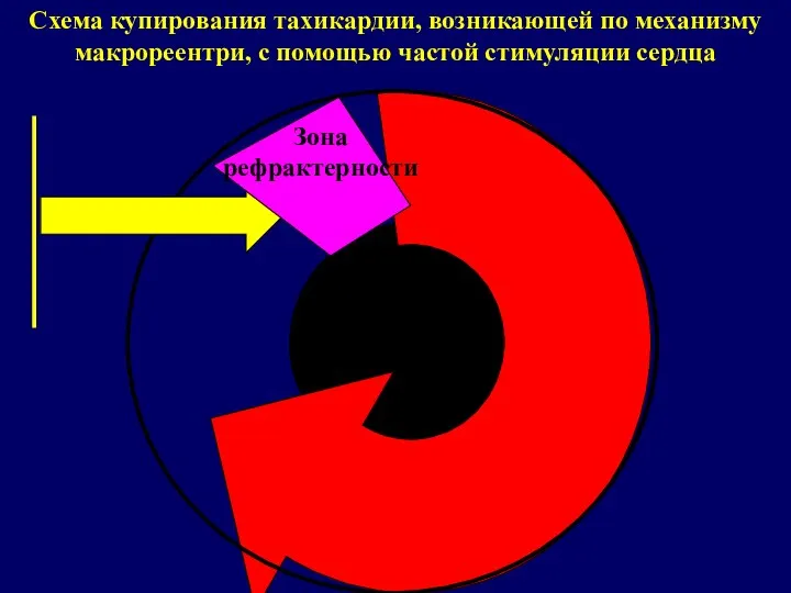 Схема купирования тахикардии, возникающей по механизму макрореентри, с помощью частой стимуляции сердца