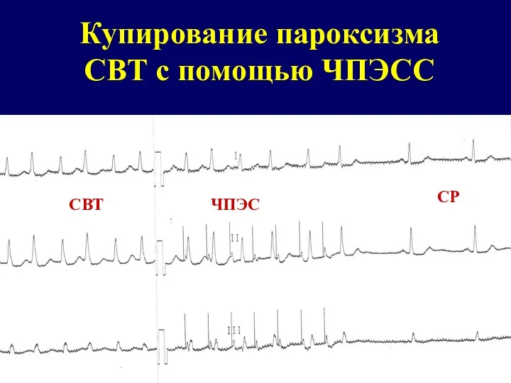 Купирование пароксизма СВТ с помощью ЧПЭСС СВТ ЧПЭС СР