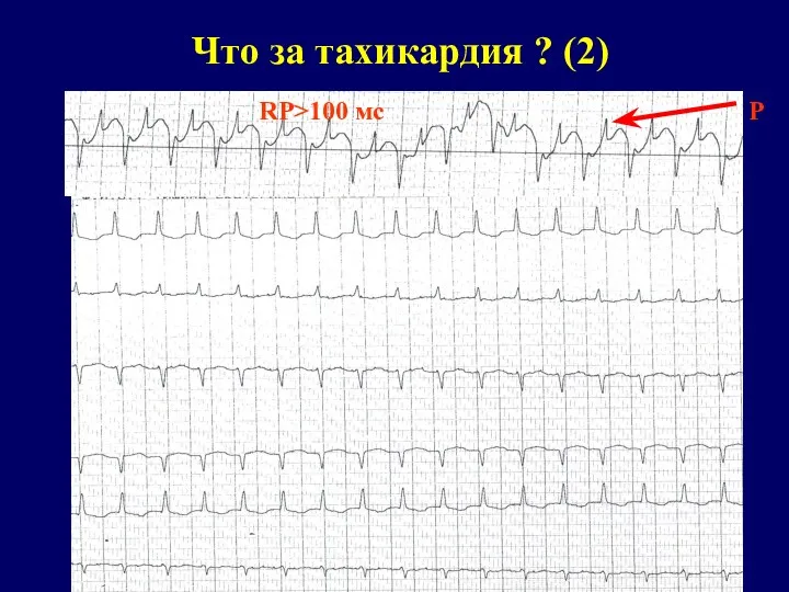 Что за тахикардия ? (2)