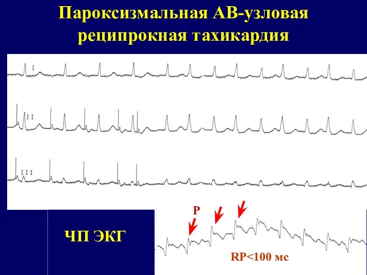 Пароксизмальная АВ-узловая реципрокная тахикардия ЧП ЭКГ Р RP