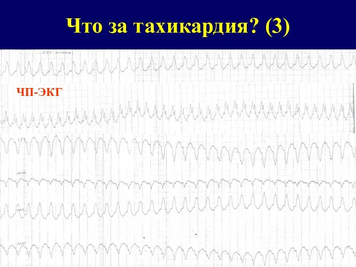 Что за тахикардия? (3)