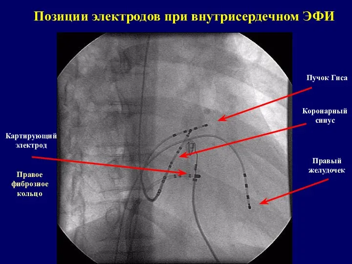 Позиции электродов при внутрисердечном ЭФИ Правый желудочек Пучок Гиса Коронарный синус Картирующий электрод Правое фиброзное кольцо