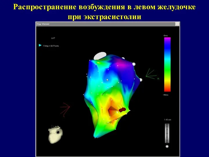 Распространение возбуждения в левом желудочке при экстрасистолии