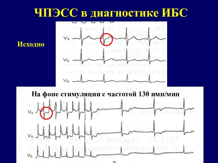 ЧПЭСС в диагностике ИБС Исходно На фоне стимуляции с частотой 130 имп/мин